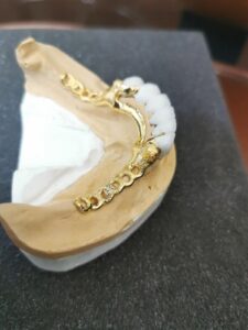 Bezmetalna keramika na zlatnoj protezi